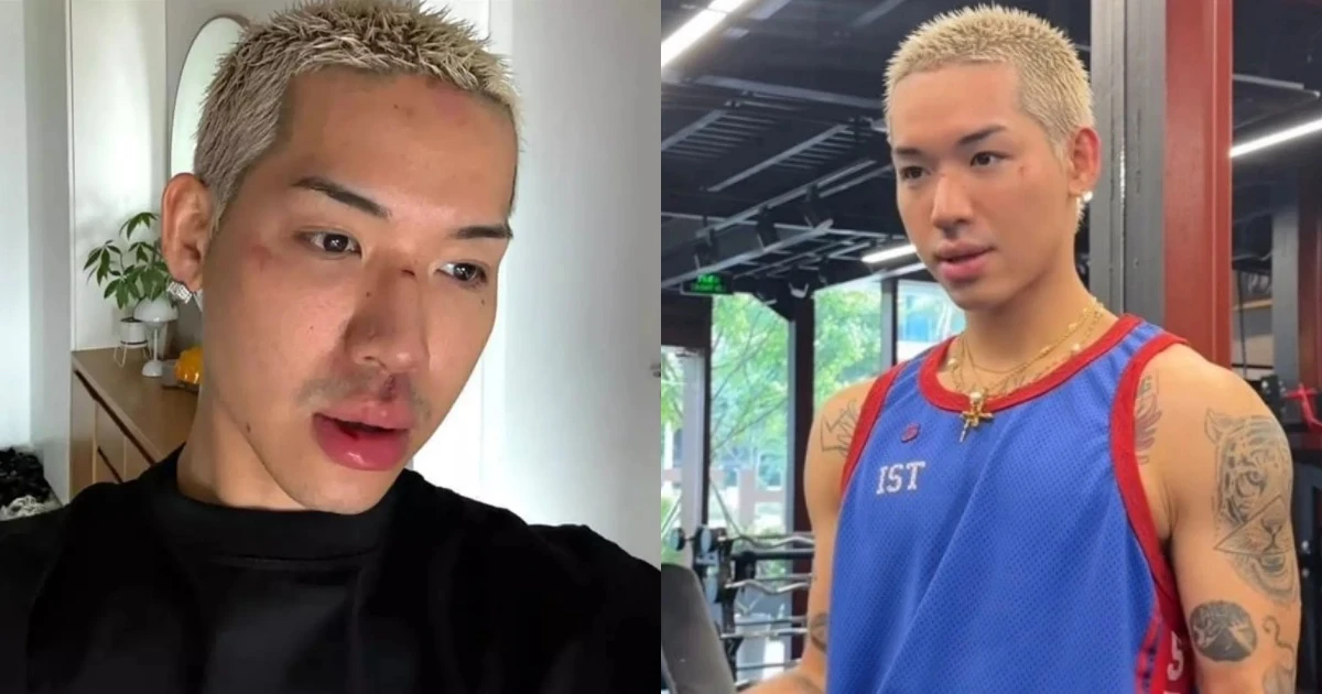 Wean Lê bất ngờ gặp nạn lúc đi đường, tình trạng đáng lo ngại | Showbiz ...